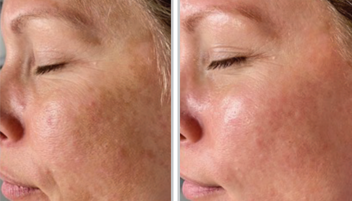 Close-up of before-and-after results from MOXI facial treatment, highlighting even skin tone and reduced pigmentation.