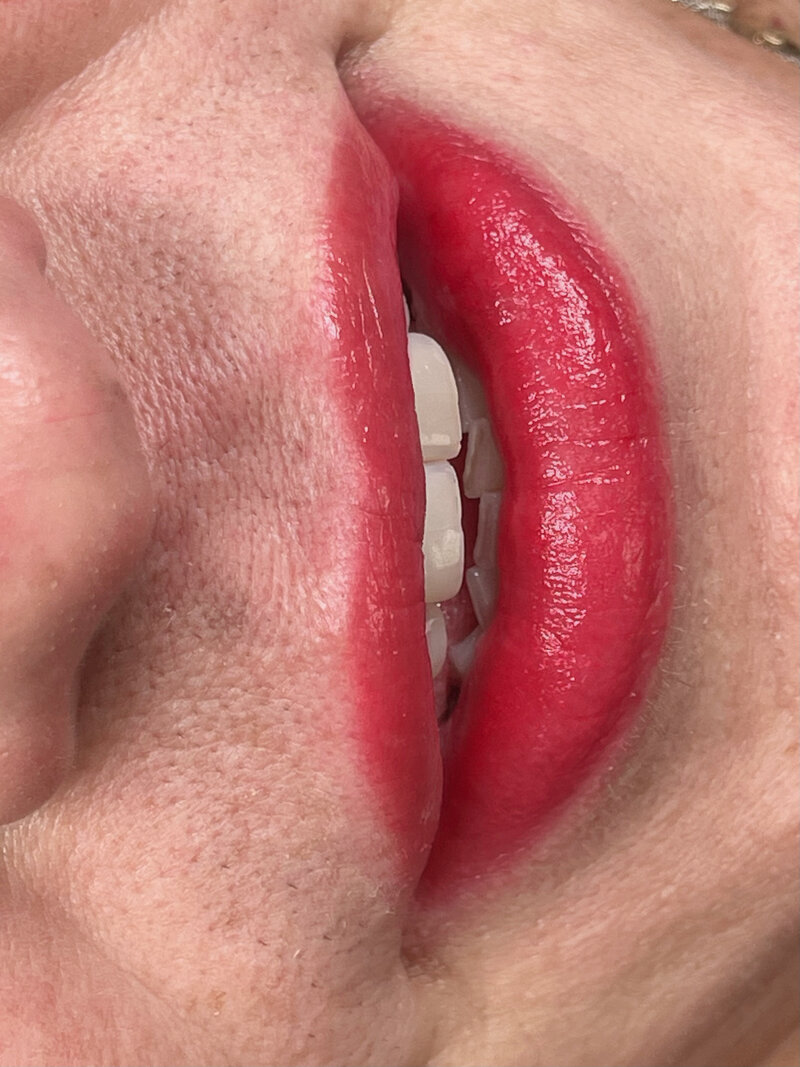 Opt for "Lip Injections for Fuller Lips in Dallas," delivering a natural-looking fullness and volume to your lips, crafted by the best Dallas esthetician.