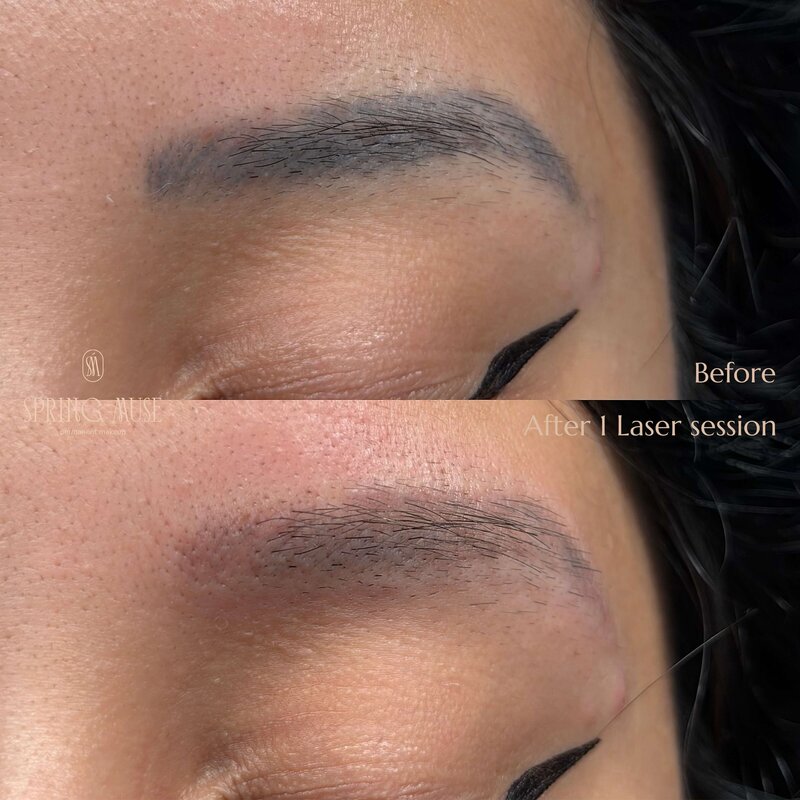 Laser Eyebrows Removal New York