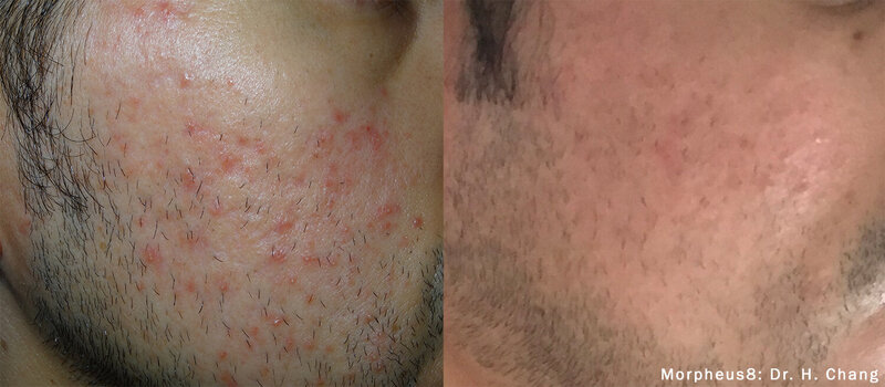 HC_Morpheus8_1_Acne1tx15kj