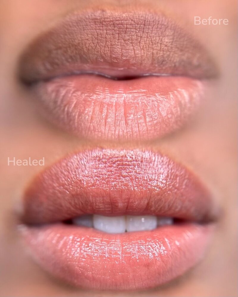 Healed Lip Neutralization