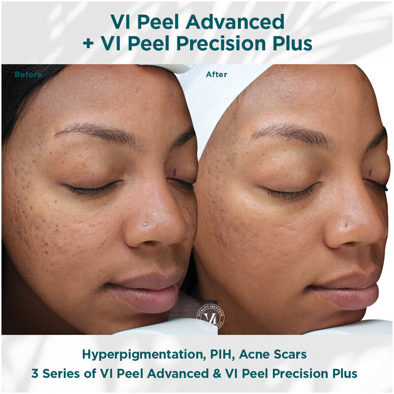 Hyperpigmentation, PIH _ Acne Scars