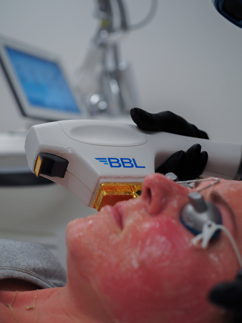 BBL Treatment 4