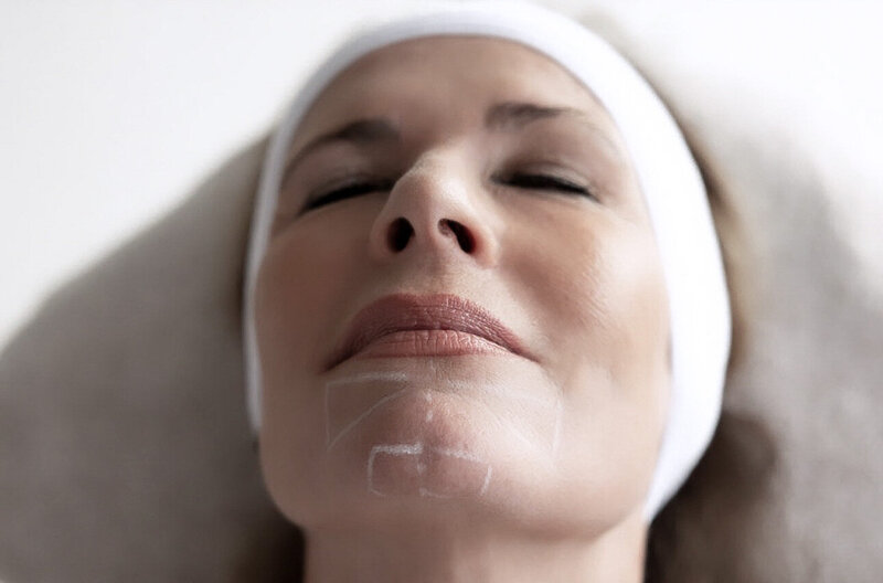 Liquid facelift Rotterdam cosmetisch arts Lizenka Adriaanse