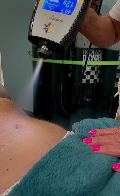 A close-up of a cryotherapy treatment being applied to a client's stomach, with a therapist's hand resting on a towel, showcasing the advanced cryotherapy services at 212 Salon, Spa, & Barbershop.