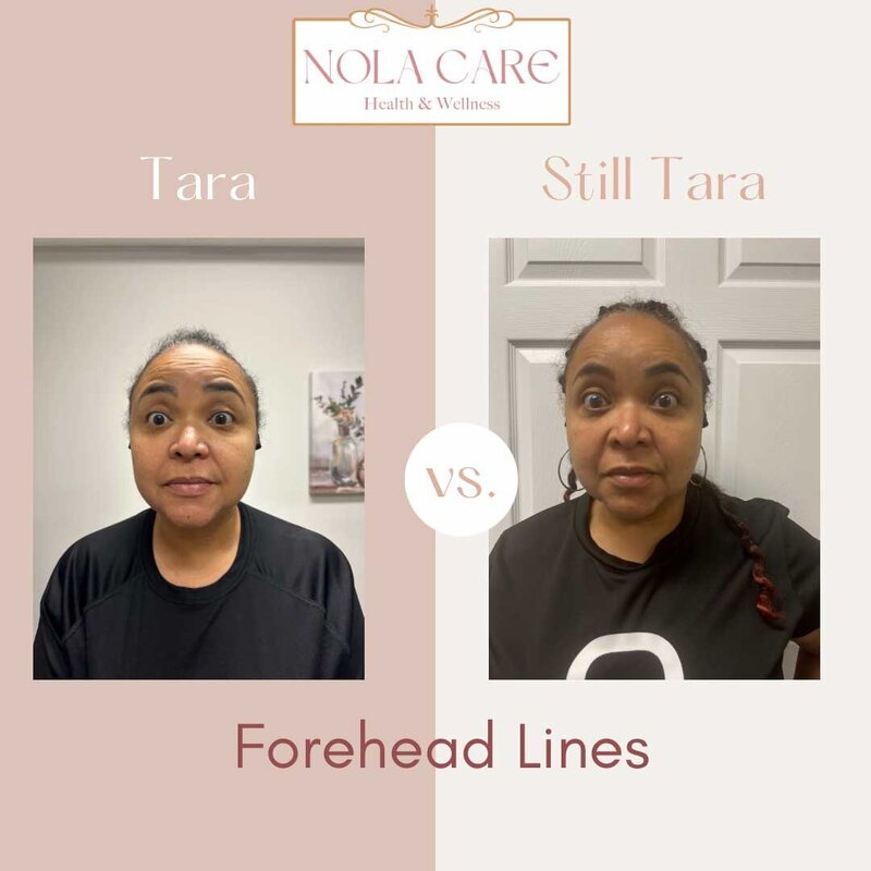 Botox treatment before and after forehead wrinkles