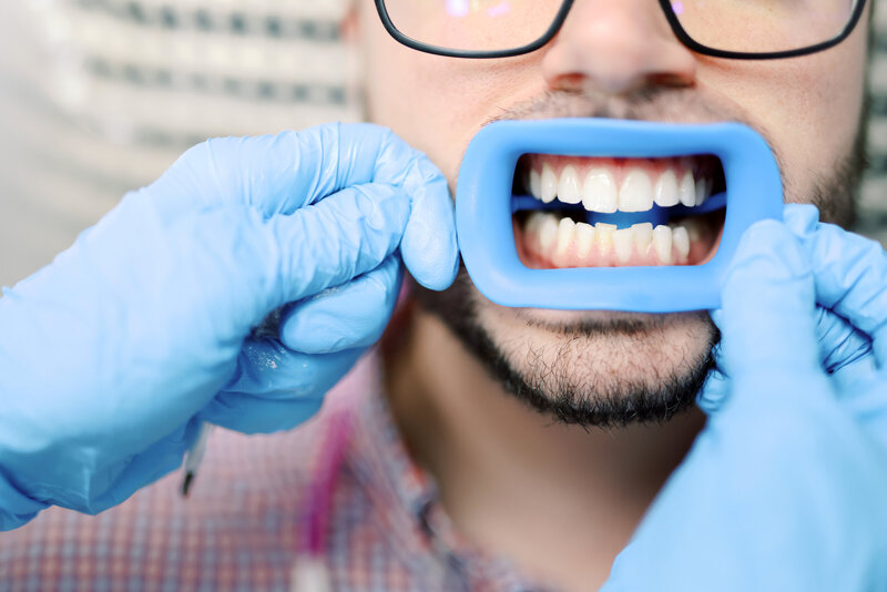 A close-up image of a person's teeth before a teeth whitening treatment, held open by a dental separator. The teeth show a natural shade with visible stains or discoloration. The separator gently holds the mouth open to provide access for the whitening process. The background includes professional dental equipment and a clean, well-lit treatment environment.