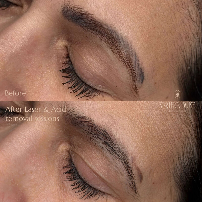 Acid and Laser removal nyc