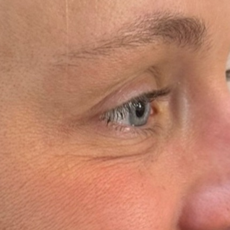 crows feet 1a