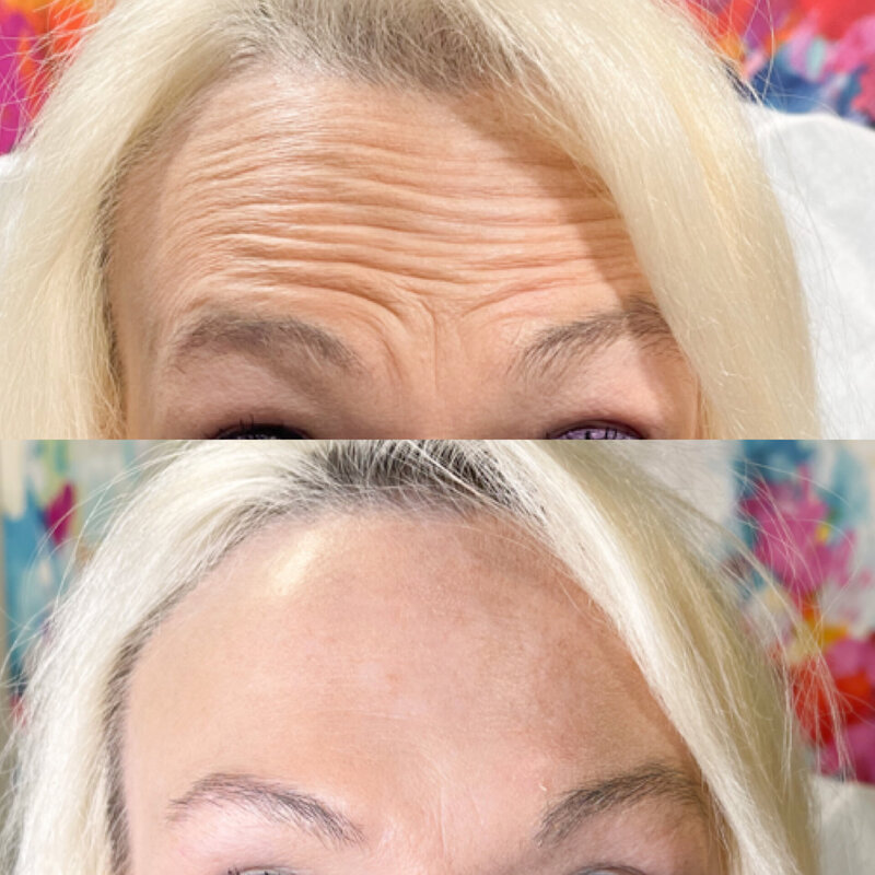 Botox in Rockwall TX 