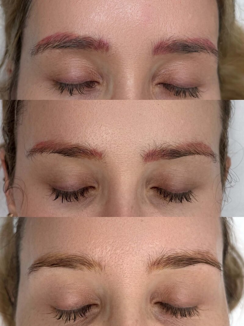 Permanent makeup removal