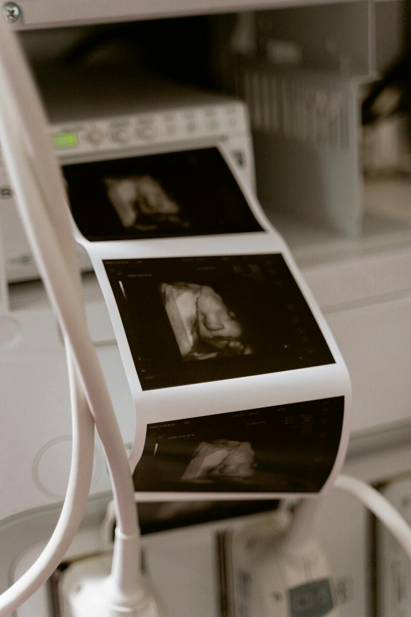 Ultrasound photo resting on a table, representing unresolved birth trauma and the emotional journey of postpartum healing through EMDR