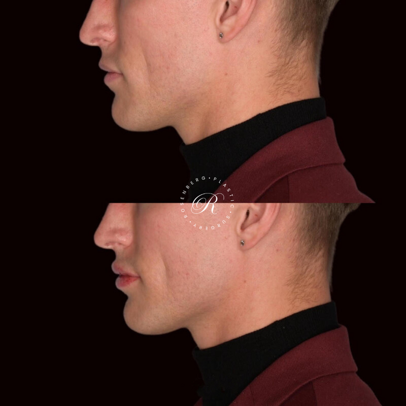 Non-surgical Lip Augmentation RPS Before & Afters.png