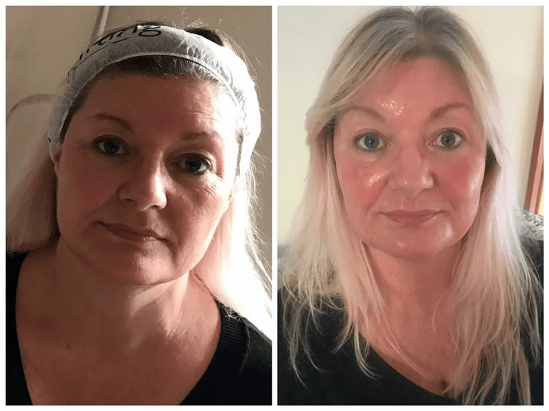 Cryolift-before-and-after