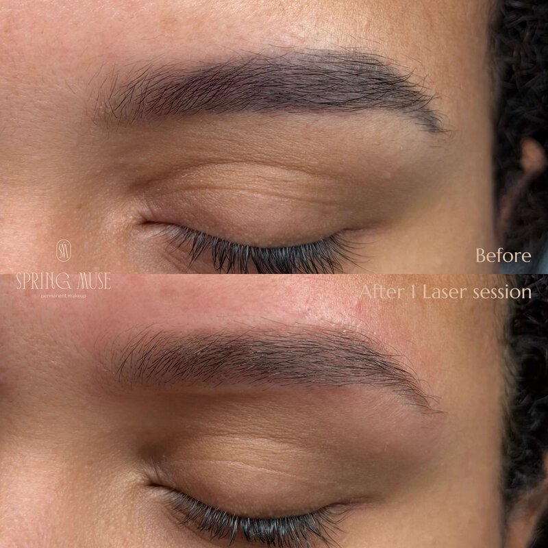 Laser Eyebrows Removal New York