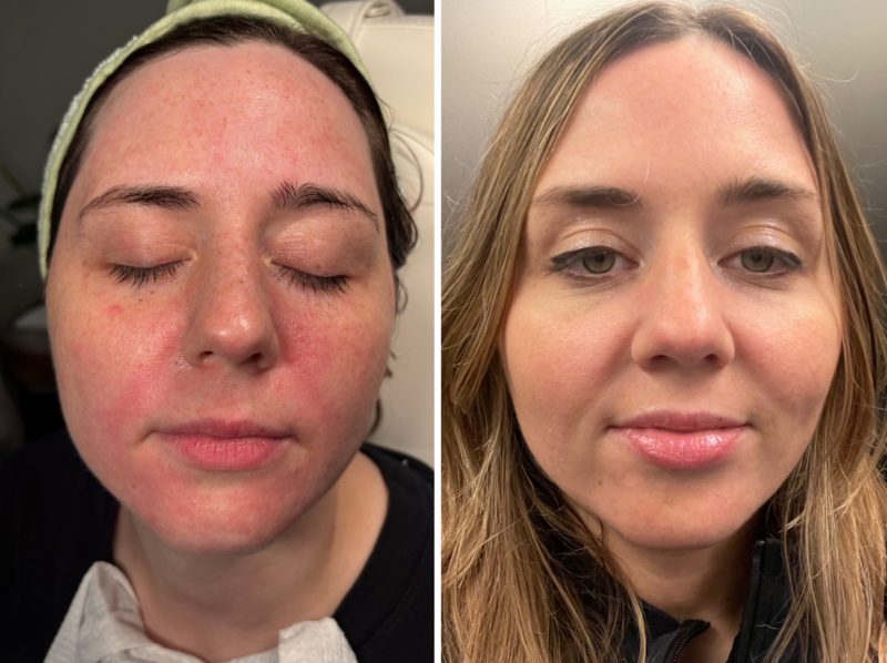 Microneedling with PRP in Cedar Rapids, IA | Kalen & Co.