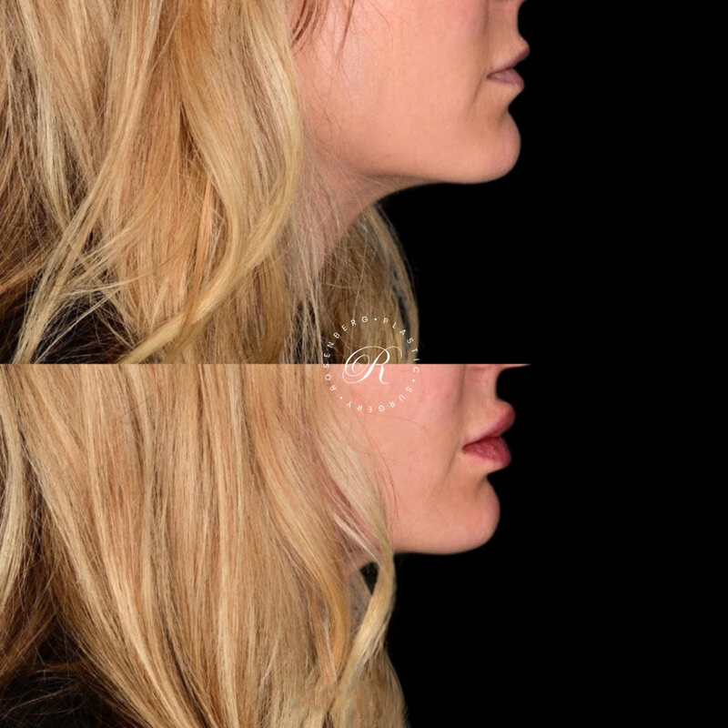 Non-surgical Lip Augmentation RPS Before & Afters.zip - 14