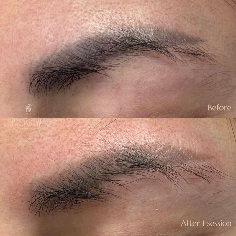 Laser Eyebrows Removal New York