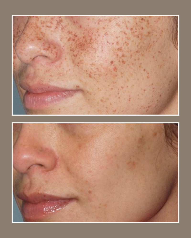 Lasers - Glösense Dermatology and Aesthetics, Miami