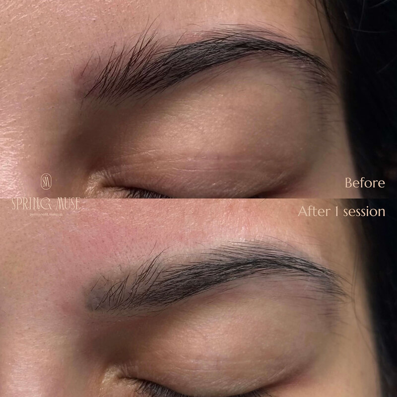 Red brows after PMU? We can remove them. NYC