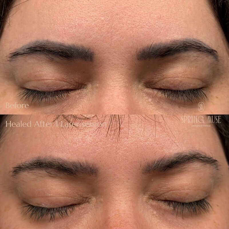 Laser Eyebrows Removal New York