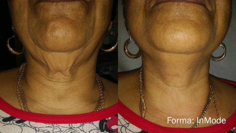 forma-before-after-inmode-preview-2