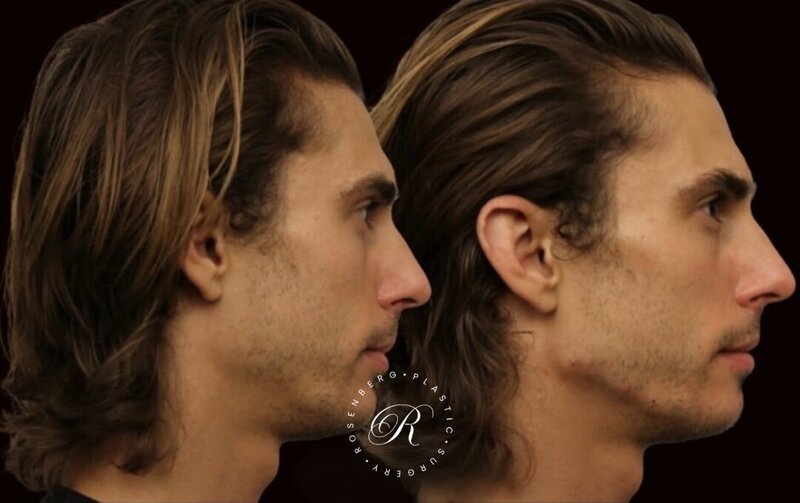 Non-surgical ChinJaw Augmentation RPS Before & After.zip - 36