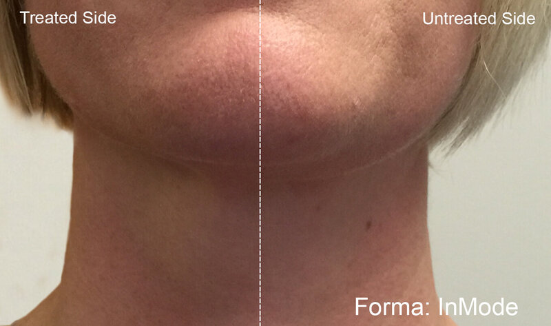forma-before-after-inmode-preview-1