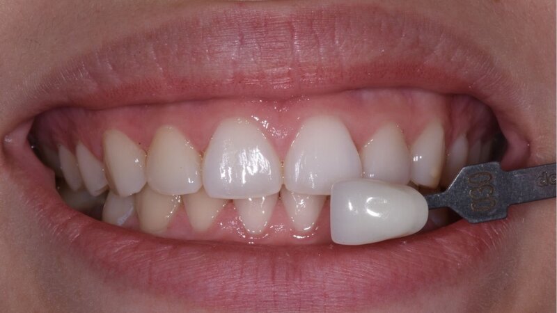 Example 3-a Photo of a patient Before getting the Zoom Whitening treatment with staining on the teeth