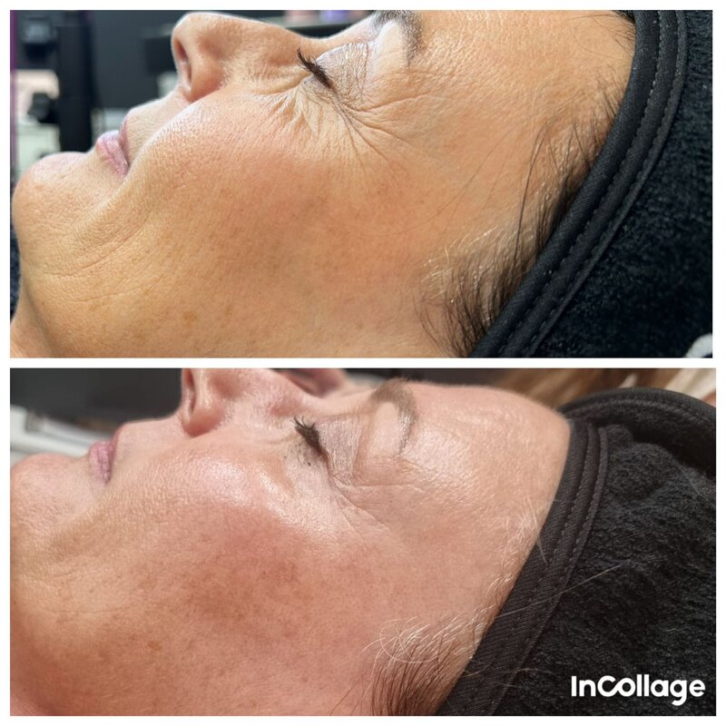 avant après du jetpeel