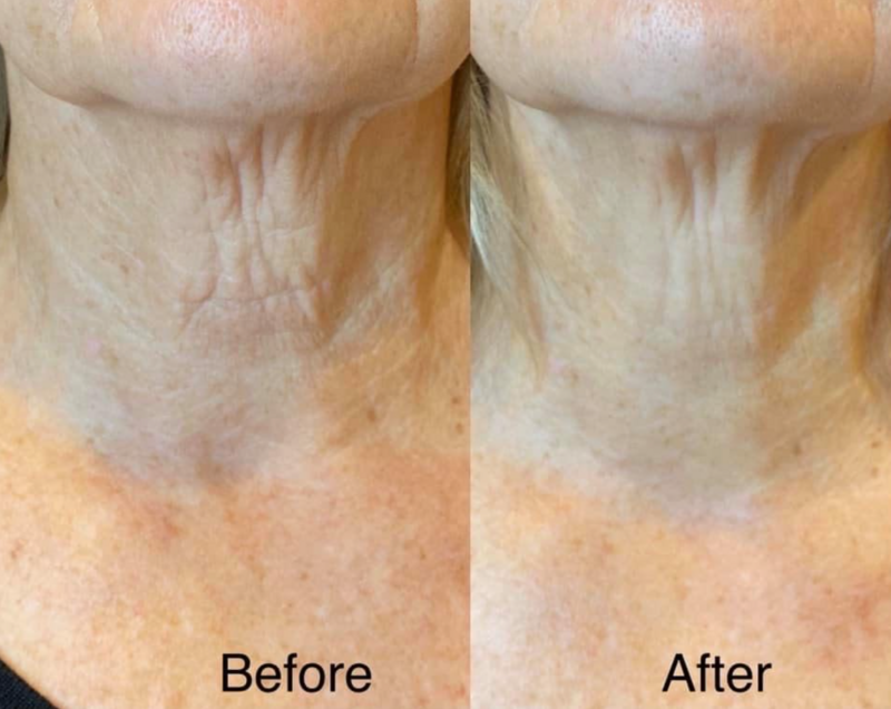 Before and after cryoskin treatment