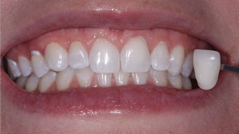 Example 2-a Photo of a patient Before getting the Zoom Whitening treatment with staining on the teeth