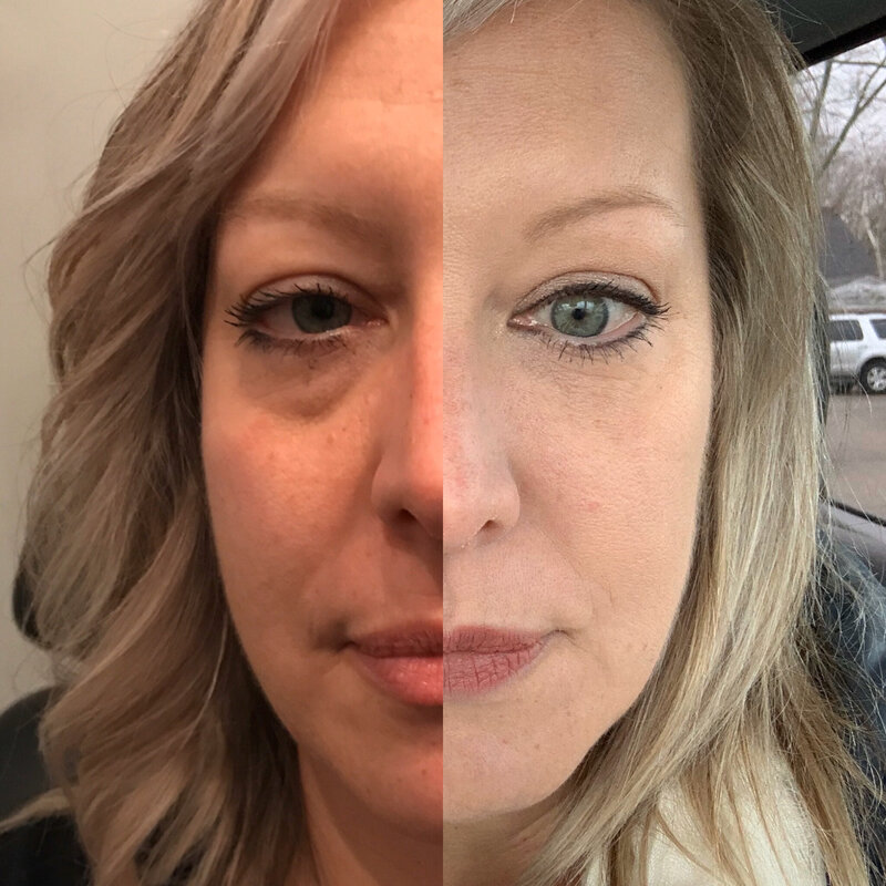Women client reduced and removed facial wrinkles and puffy