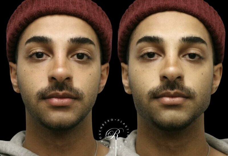 Non-surgical ChinJaw Augmentation RPS Before & After.zip - 10