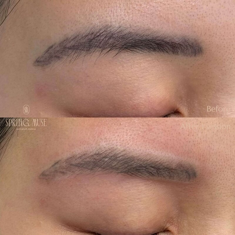 Laser Eyebrows Removal New York