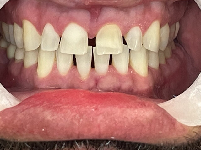 Olympus-Dental-Ceramics-W-01-Before