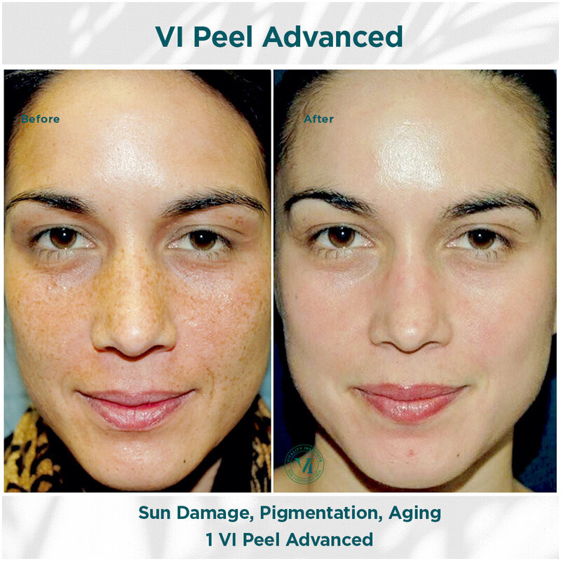 Sun Damage, Pigmentation _ Aging