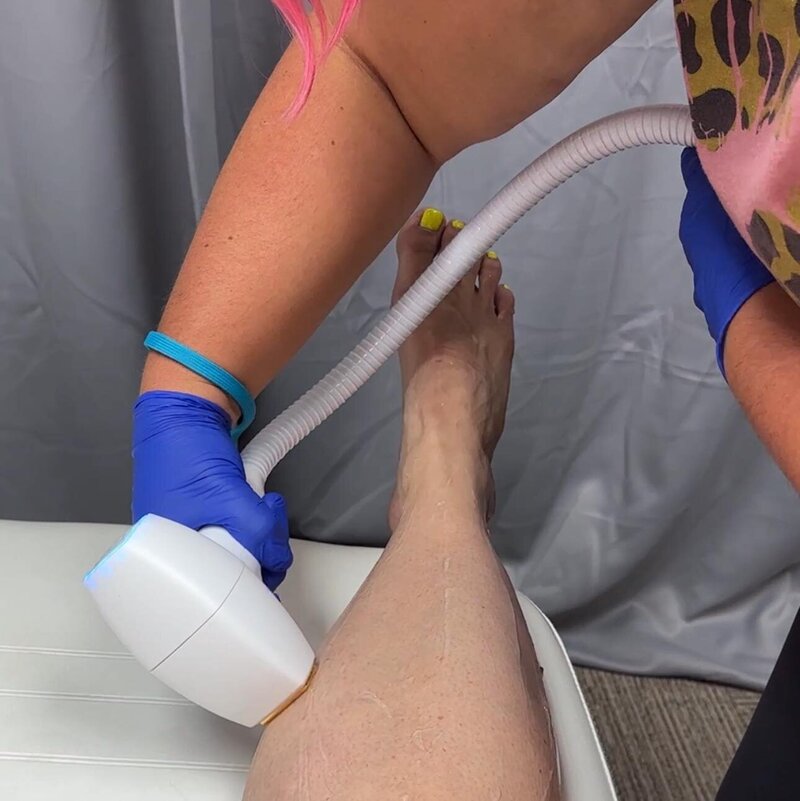 Woman having lazer hair removal done on leg