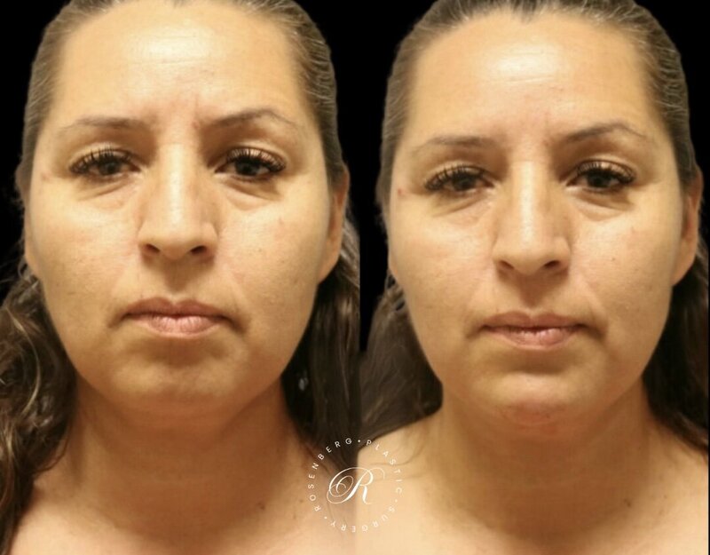Non-surgical ChinJaw Augmentation RPS Before & After 5.png