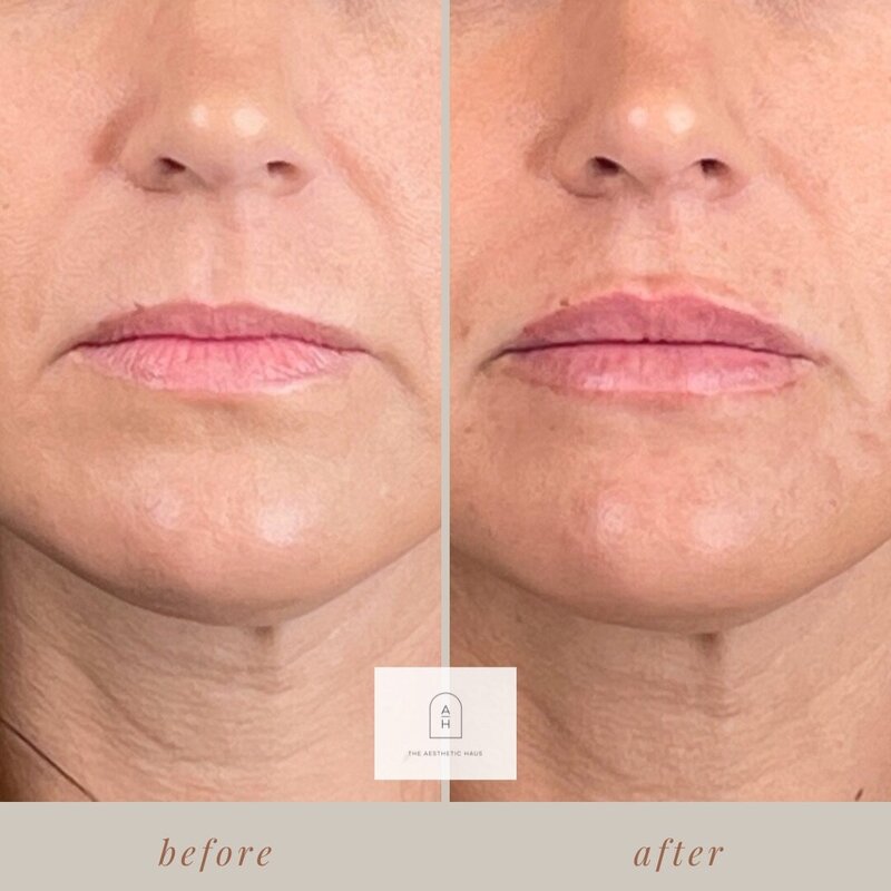 Alli- Juve - Lip Filler 1