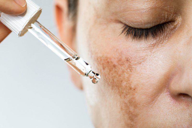 woman with eyes closed applying an oil to the melasma patch on her cheek
