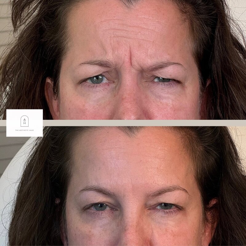 Botox 1