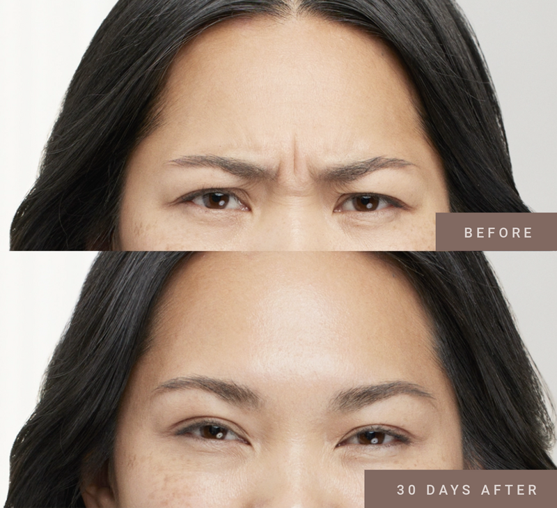 Botox-1