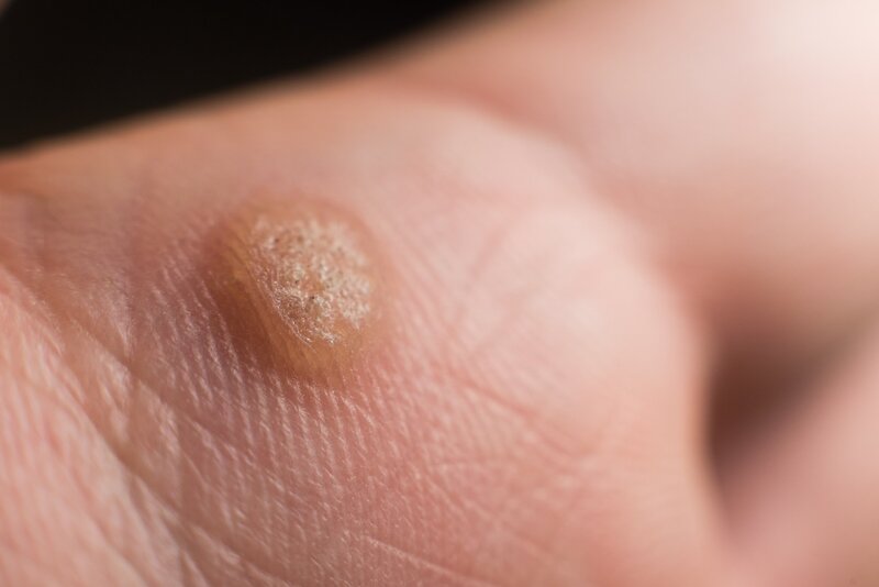 close up of a wart on palm of the hand