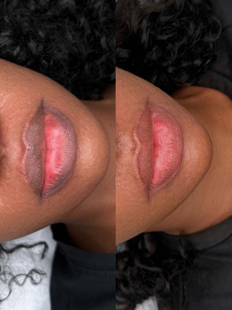 lips neutralization in New York
