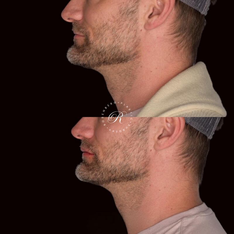 Non-surgical ChinJaw Augmentation RPS Before & After.zip - 54