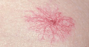 spider neavi ultra skin clinic huidtherapie vaatlaser