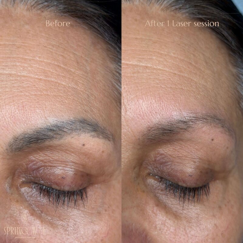 Laser Eyebrows Removal New York
