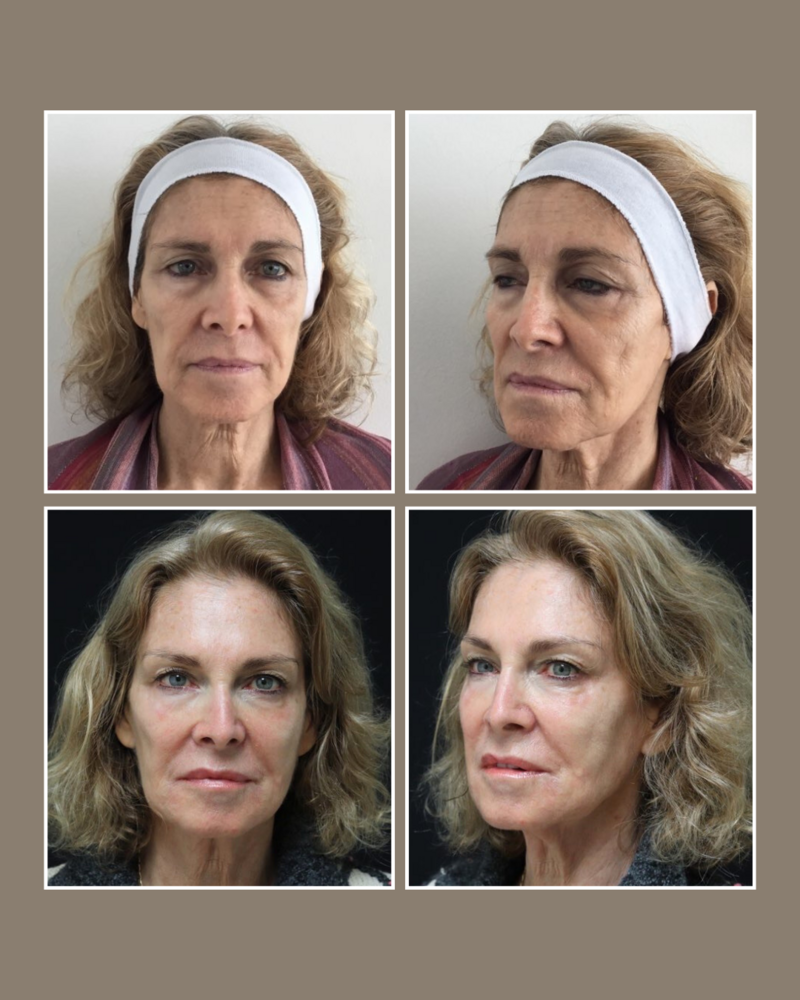 Injectables - Glösense Dermatology and Aesthetics, Miami