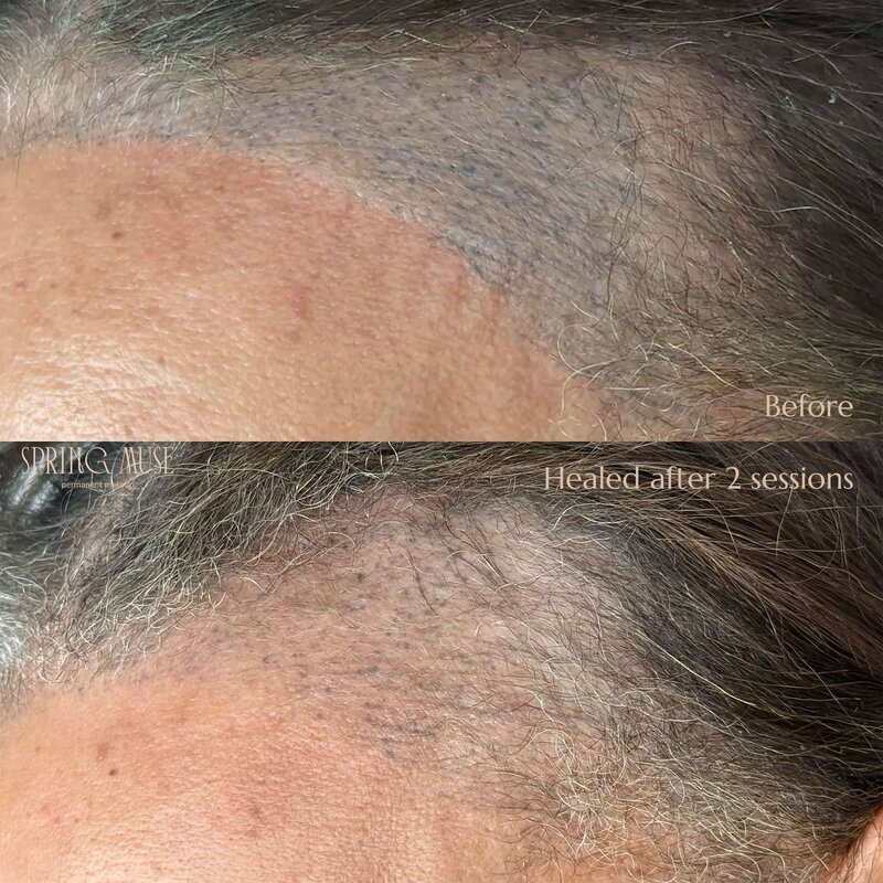 Laser Scalp removal NYC